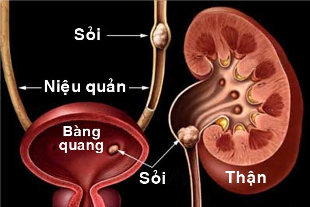 Nhiều dạng sỏi khác nhau trong cơ thể