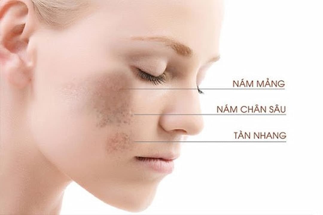 Niacinamide thường được dùng để cải thiện tình trạng tăng sắc tố da