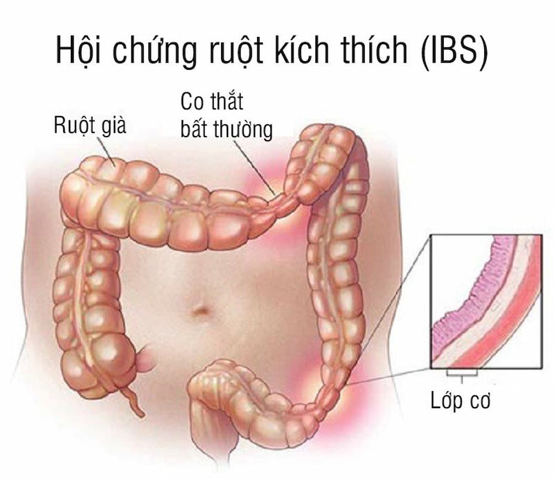 Nhận diện hội chứng ruột kích thích thể táo bón - Hỏi đáp