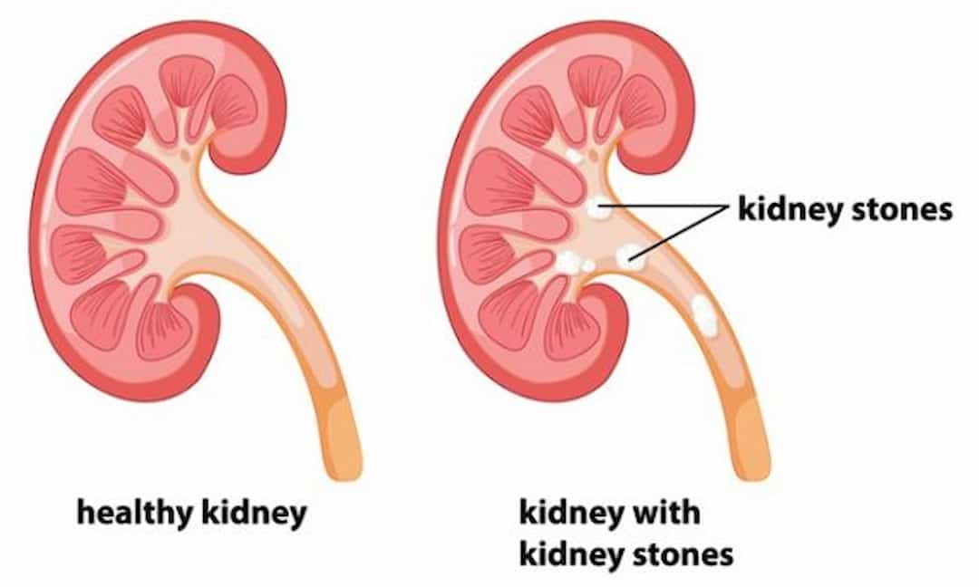 Nguyên nhân gây sỏi thận do chế độ ăn uống, sinh hoạt