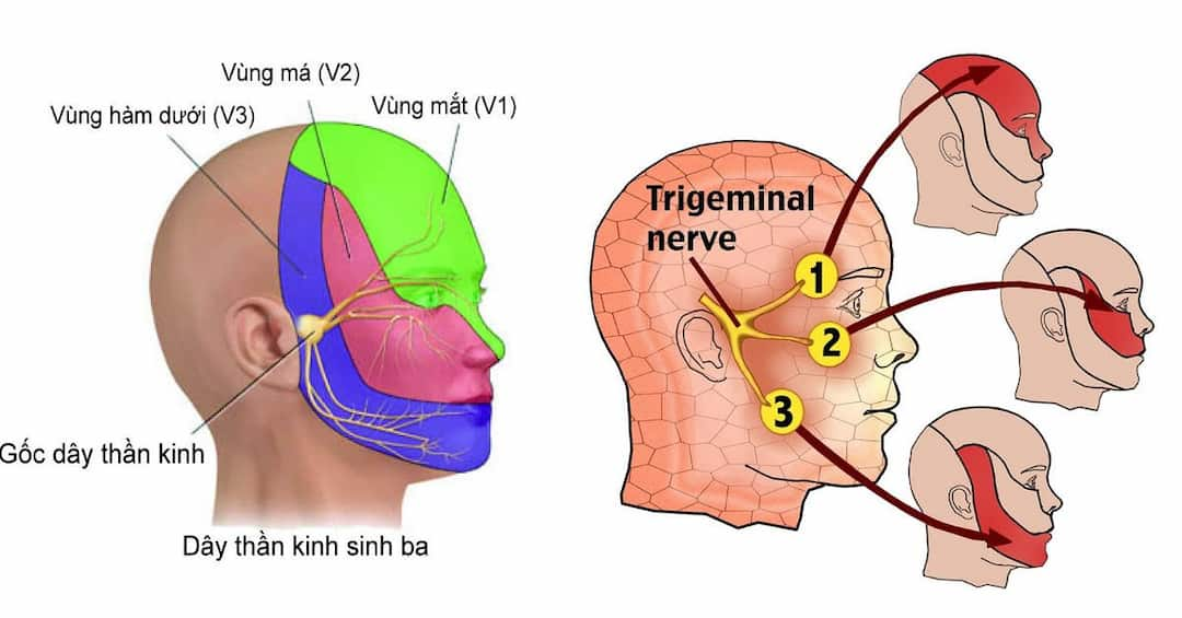 Những biến chứng của bệnh đau đầu