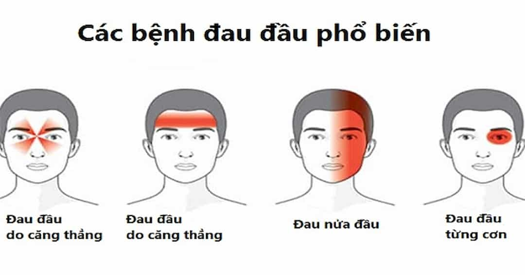 Cách phòng tránh bệnh đau đầu