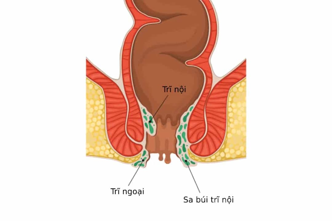 Cẩn thận bệnh trĩ